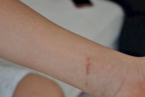 Evinin önünde köpek ısırdı